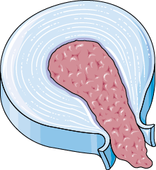 stretchingpro-hernie-discale-sequestration
